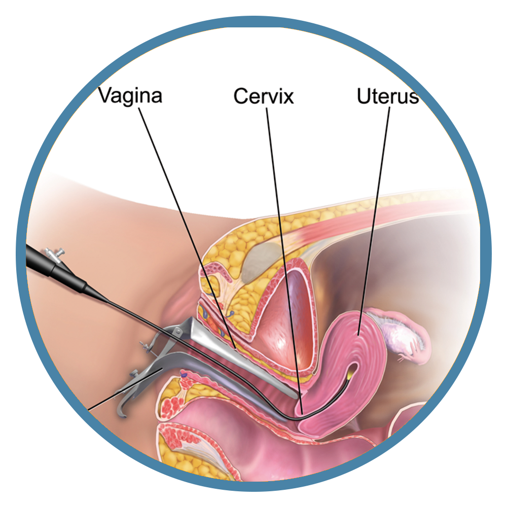 Isteroscopia Diagnostica